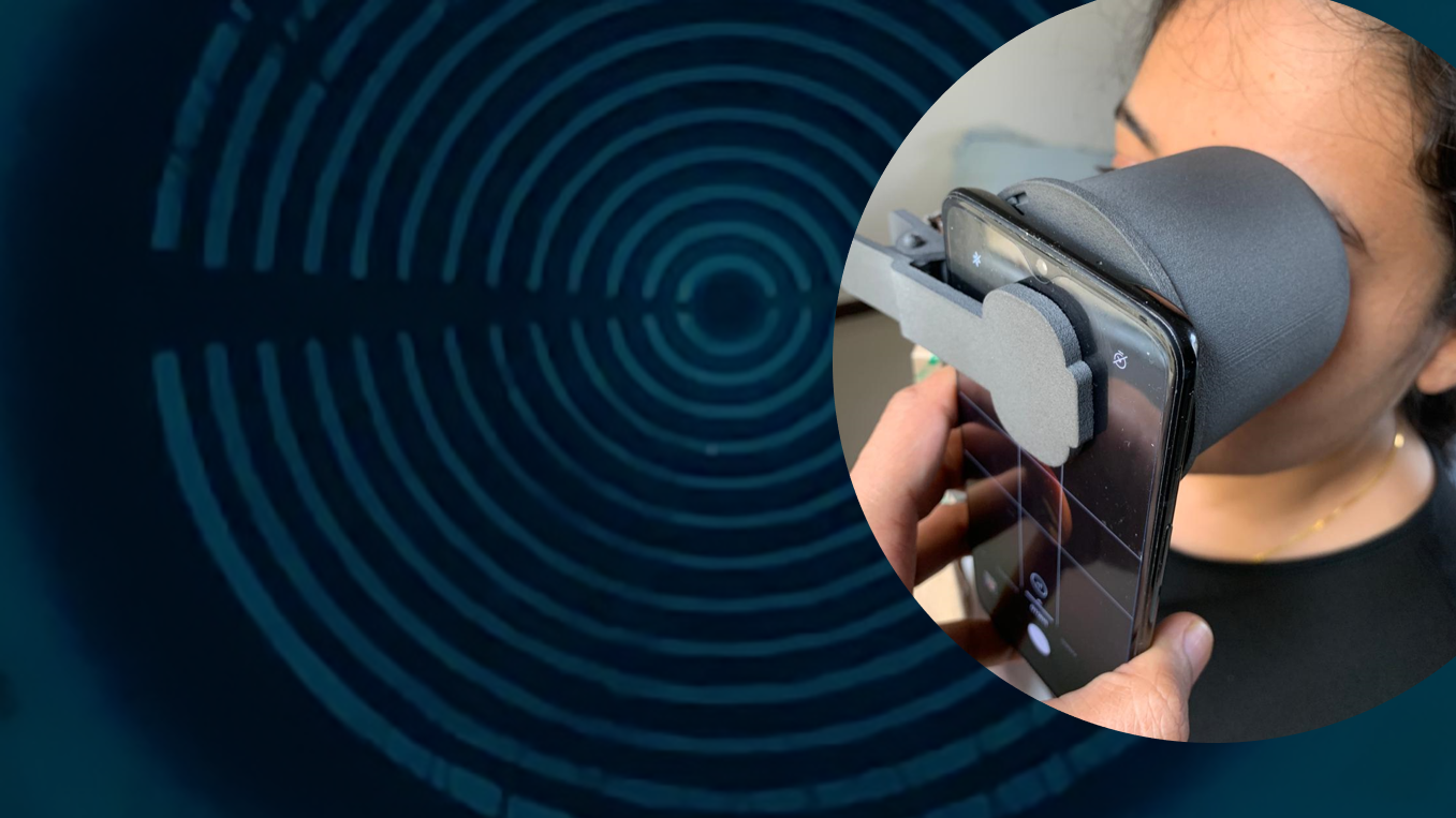 Low-cost Smartphone-based Corneal Topographer