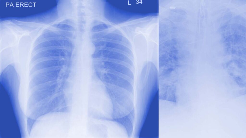 Chest radiography (CXR)