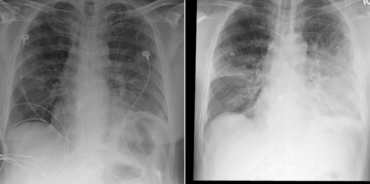 Two chest x-rays side-by-side animated with bounding boxes and attention maps on the affected area of the lung.